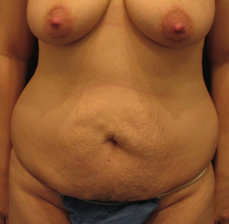 Tummy Tuck Before & After Gallery - Patient 174179775 - Image 1