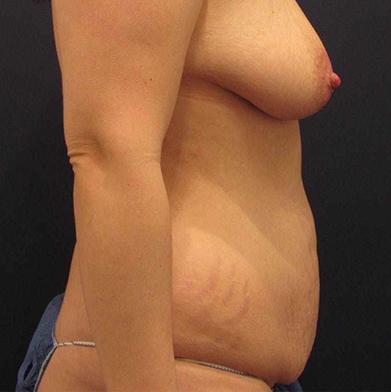 Tummy Tuck Before & After Gallery - Patient 174179775 - Image 5
