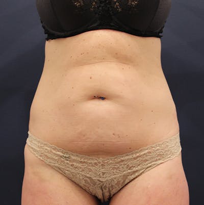 Tummy Tuck Before & After Gallery - Patient 174180852 - Image 1