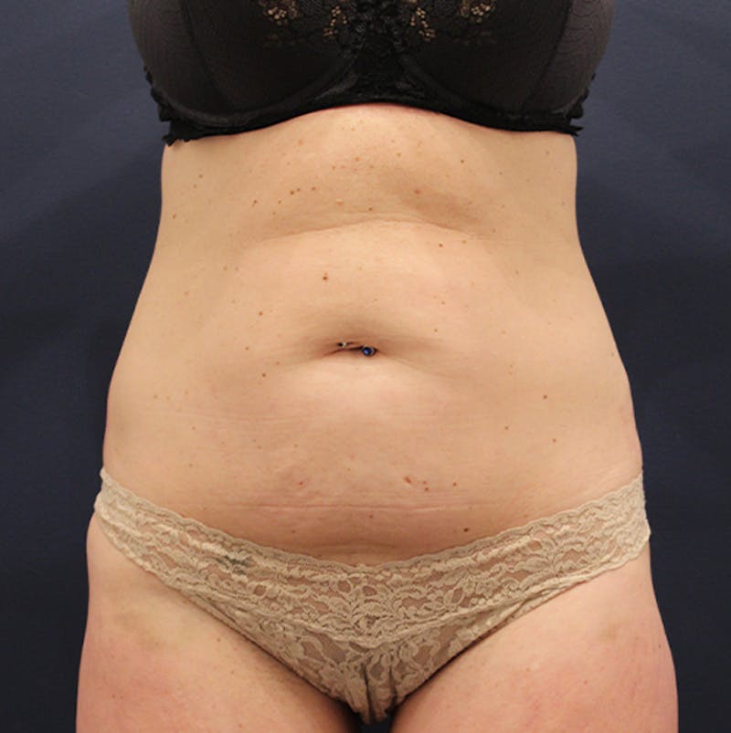 Tummy Tuck Before & After Gallery - Patient 174180852 - Image 1