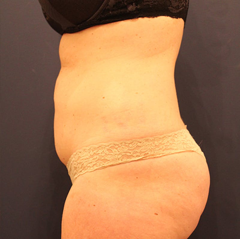 Tummy Tuck Before & After Gallery - Patient 174180852 - Image 3