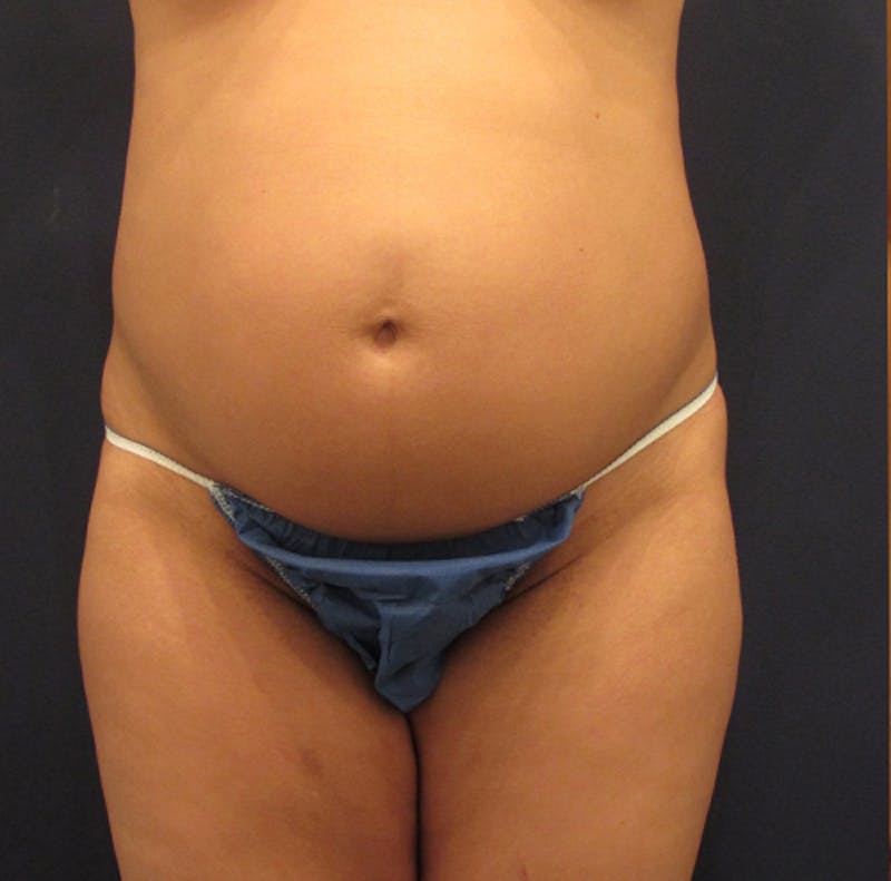 Tummy Tuck Before & After Gallery - Patient 174180856 - Image 1