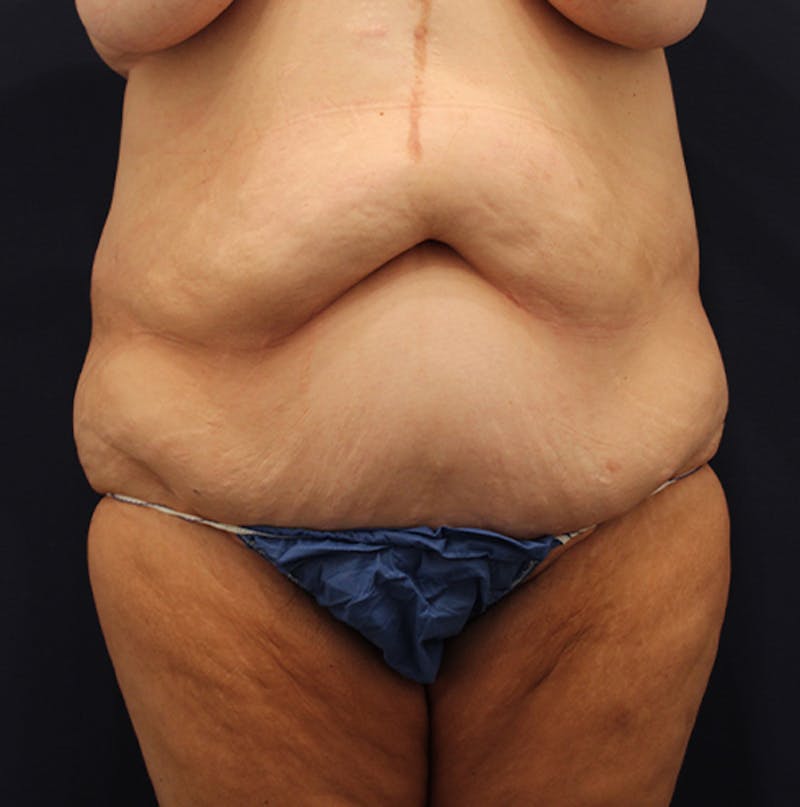Tummy Tuck Before & After Gallery - Patient 174180858 - Image 1