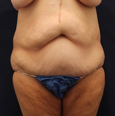 Tummy Tuck Before & After Gallery - Patient 174180858 - Image 1