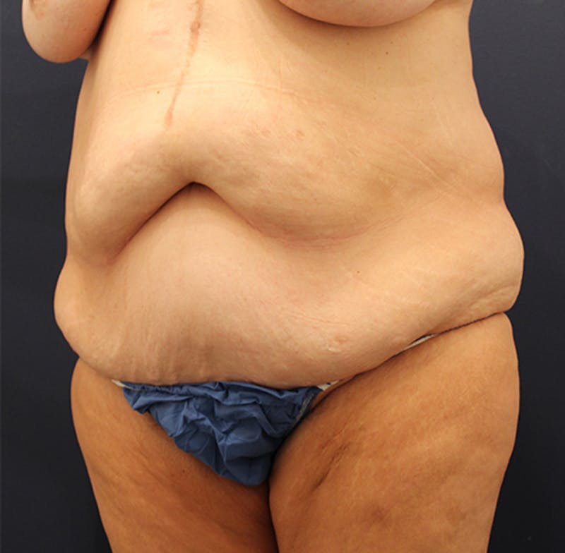 Tummy Tuck Before & After Gallery - Patient 174180858 - Image 3