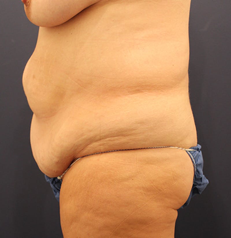 Tummy Tuck Before & After Gallery - Patient 174180858 - Image 5