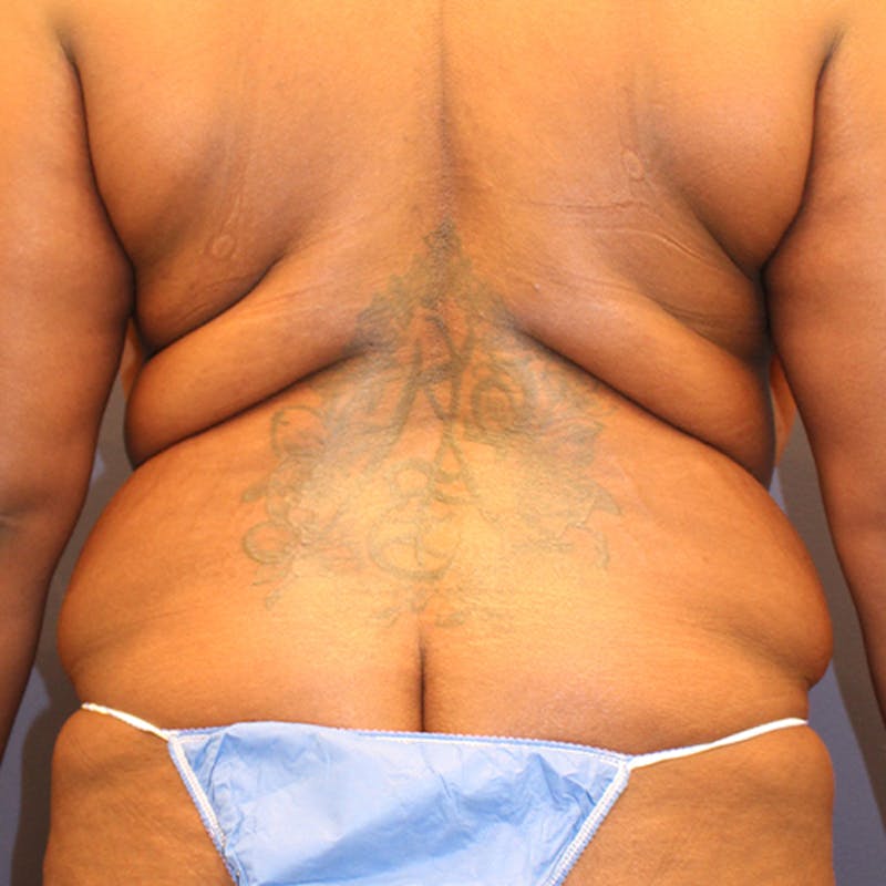 Tummy Tuck Before & After Gallery - Patient 174180860 - Image 5