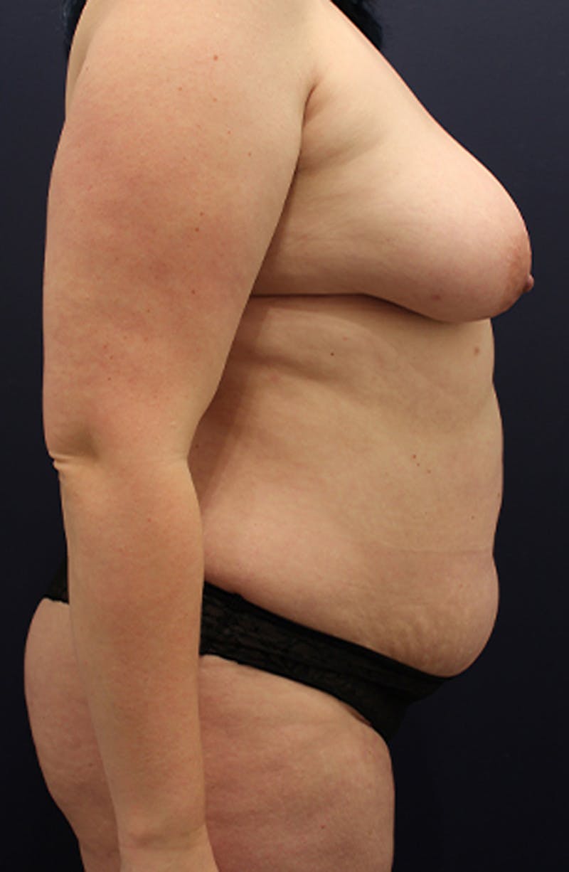 Tummy Tuck Before & After Gallery - Patient 174180861 - Image 3