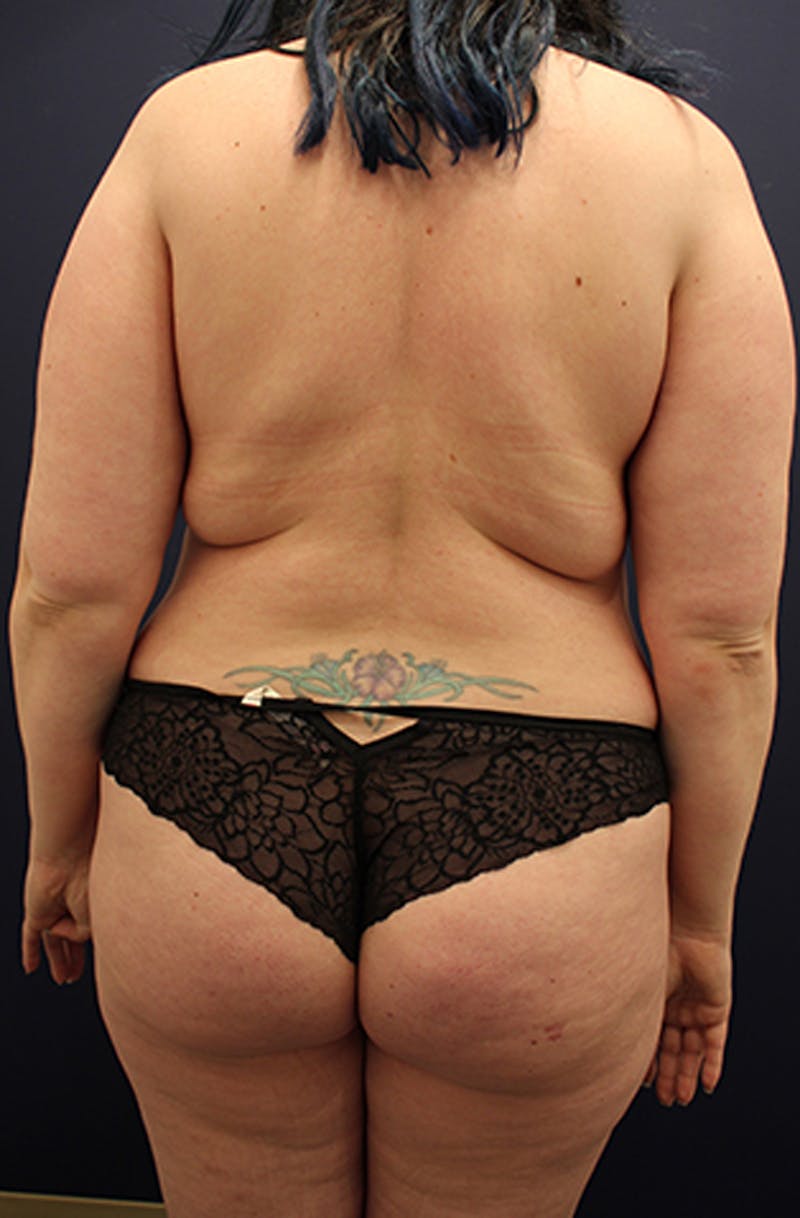 Tummy Tuck Before & After Gallery - Patient 174180861 - Image 5
