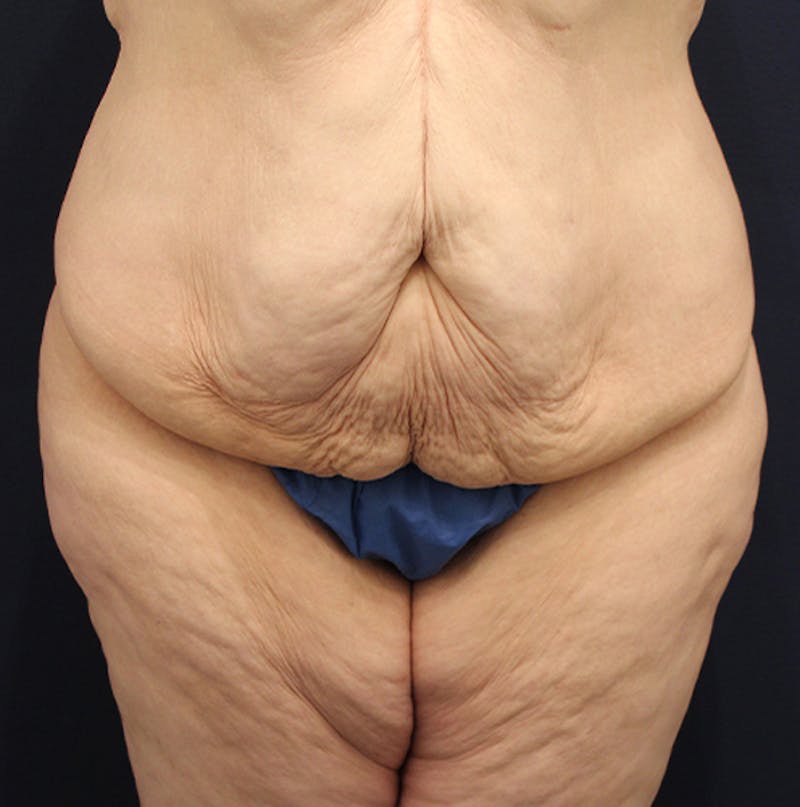 Tummy Tuck Before & After Gallery - Patient 174180862 - Image 1