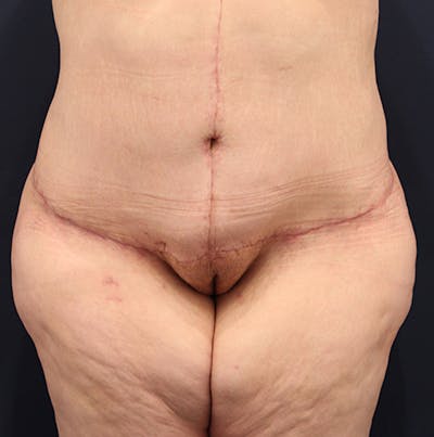 Tummy Tuck Before & After Gallery - Patient 174180862 - Image 2