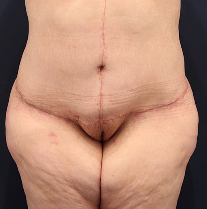 Tummy Tuck Before & After Gallery - Patient 174180862 - Image 2