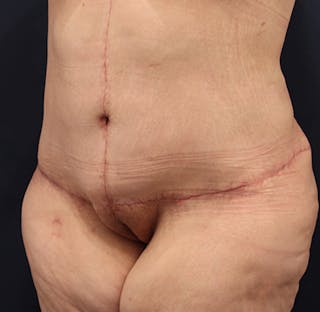 Tummy Tuck Before & After Gallery - Patient 174180862 - Image 4