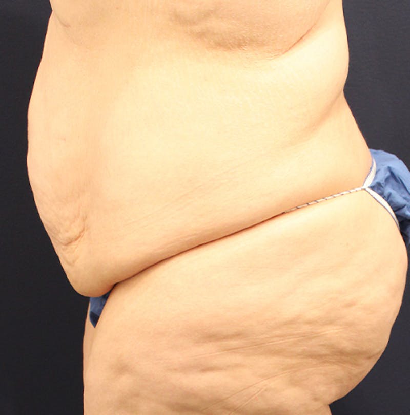 Tummy Tuck Before & After Gallery - Patient 174180862 - Image 5