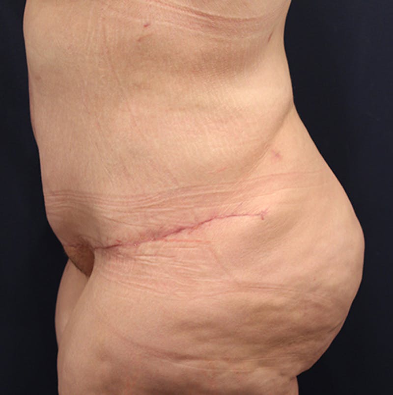 Tummy Tuck Before & After Gallery - Patient 174180862 - Image 6