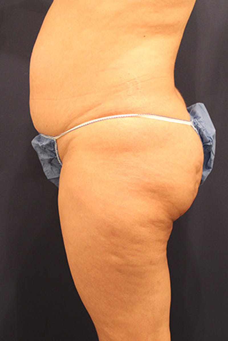 Brazilian Butt Lift Before & After Gallery - Patient 174163185 - Image 3