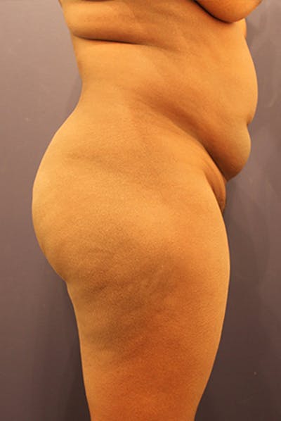 Brazilian Butt Lift Before & After Gallery - Patient 174163195 - Image 1