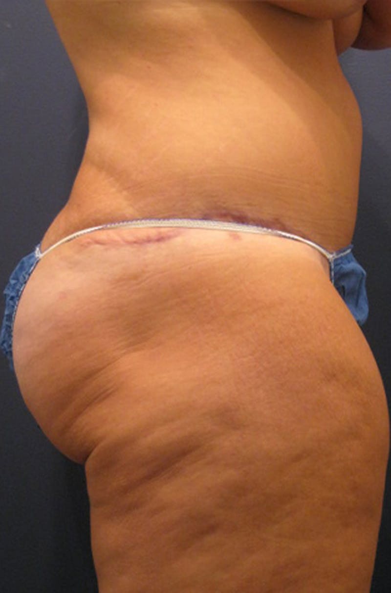 Brazilian Butt Lift Before & After Gallery - Patient 174163208 - Image 2