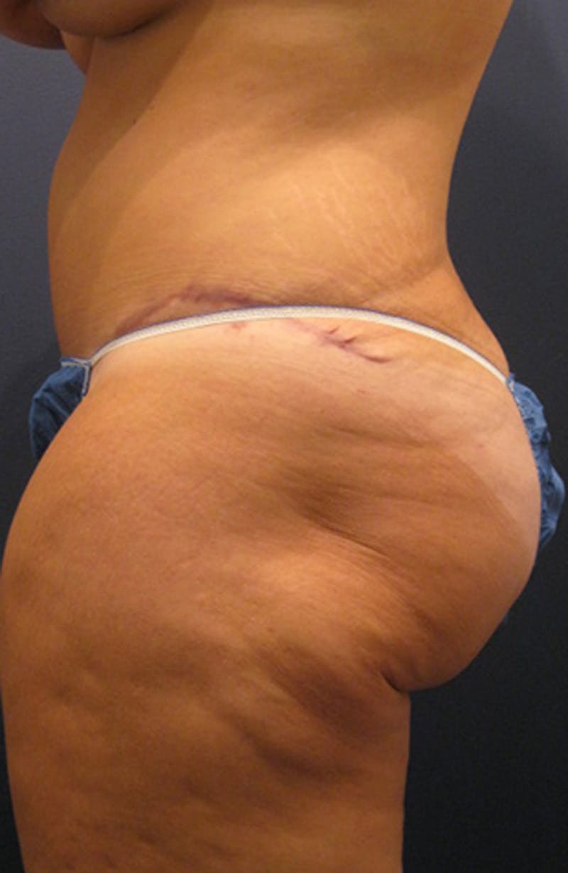 Brazilian Butt Lift Before & After Gallery - Patient 174163208 - Image 4