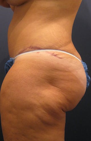 Brazilian Butt Lift Before & After Gallery - Patient 174163208 - Image 4