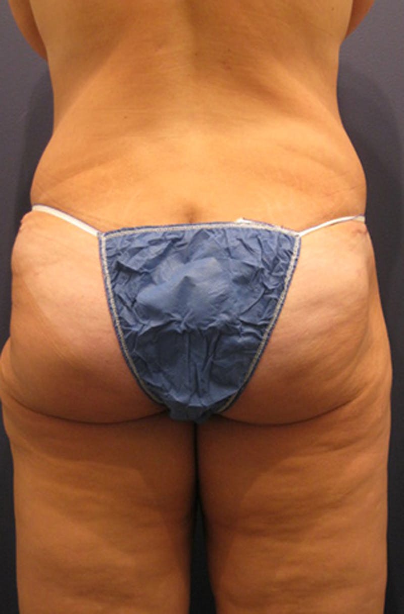 Brazilian Butt Lift Before & After Gallery - Patient 174163208 - Image 6