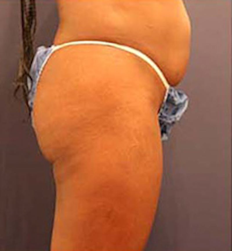 Brazilian Butt Lift Before & After Gallery - Patient 174163200 - Image 5