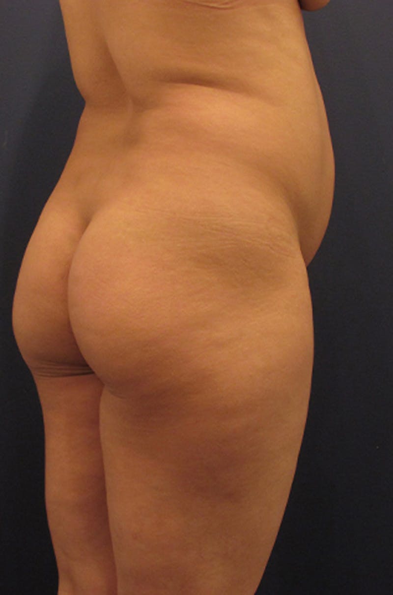 Brazilian Butt Lift Before & After Gallery - Patient 174163222 - Image 3