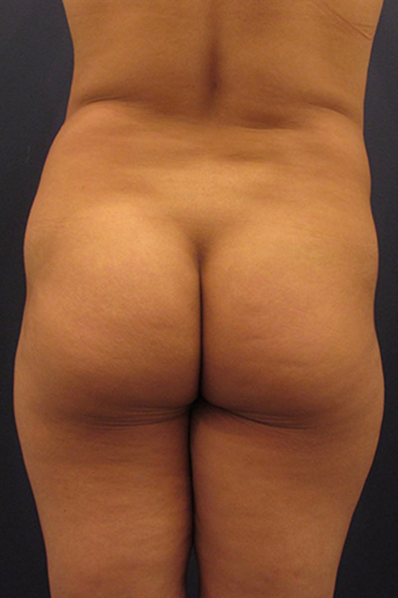 Brazilian Butt Lift Before & After Gallery - Patient 174163222 - Image 5