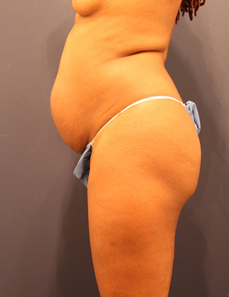 Brazilian Butt Lift Before & After Gallery - Patient 174163232 - Image 1