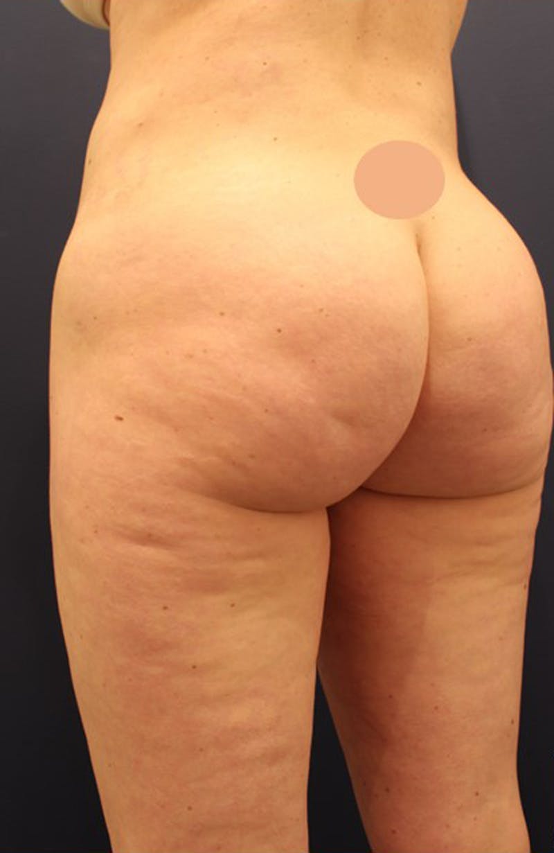 Aveli Cellulite Treatment Before & After Gallery - Patient 174163209 - Image 1