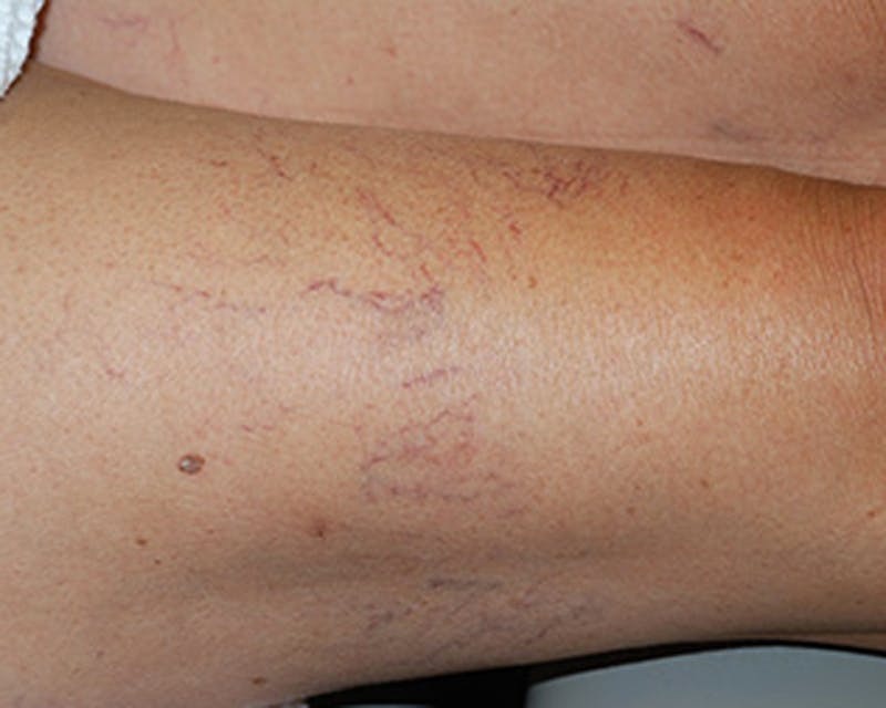 Spider Vein Treatment Before & After Gallery - Patient 174163242 - Image 1
