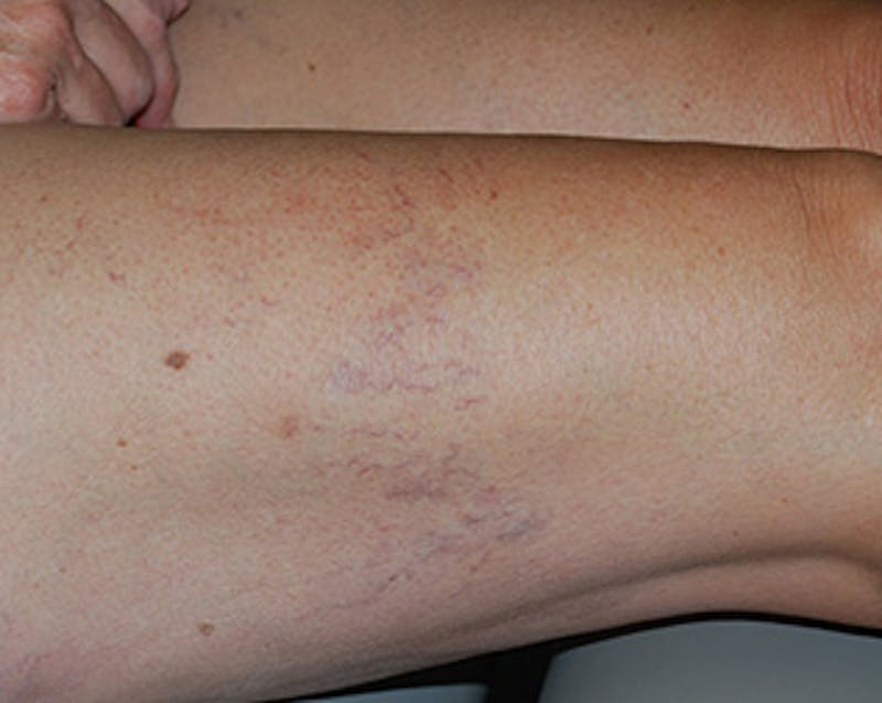 Spider Vein Treatment Before & After Gallery - Patient 174163242 - Image 2