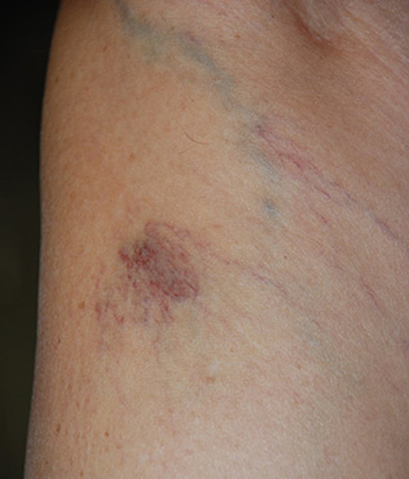 Spider Vein Treatment Before & After Gallery - Patient 174163242 - Image 3