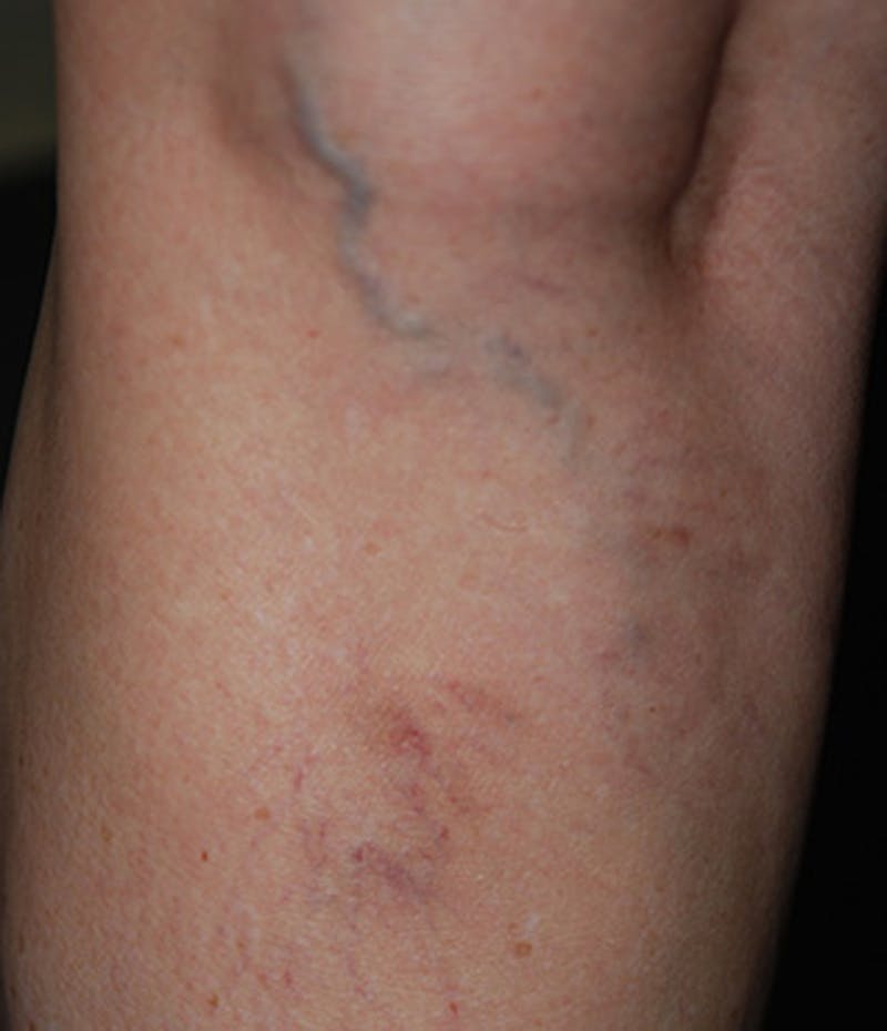 Spider Vein Treatment Before & After Gallery - Patient 174163242 - Image 4