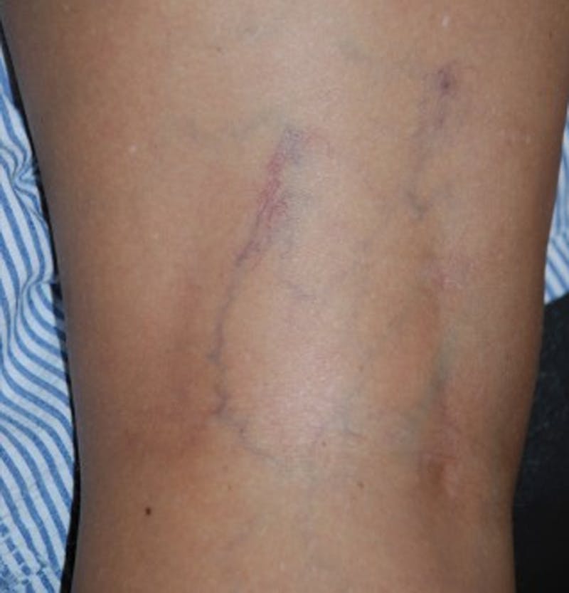 Spider Vein Treatment Before & After Gallery - Patient 174163249 - Image 1