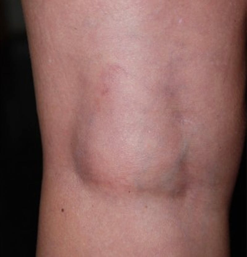 Spider Vein Treatment Before & After Gallery - Patient 174163249 - Image 2