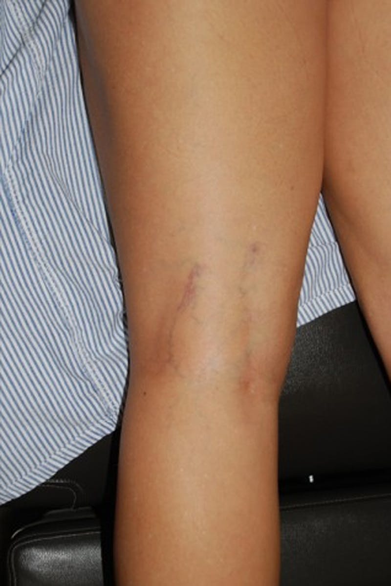 Spider Vein Treatment Before & After Gallery - Patient 174163249 - Image 3