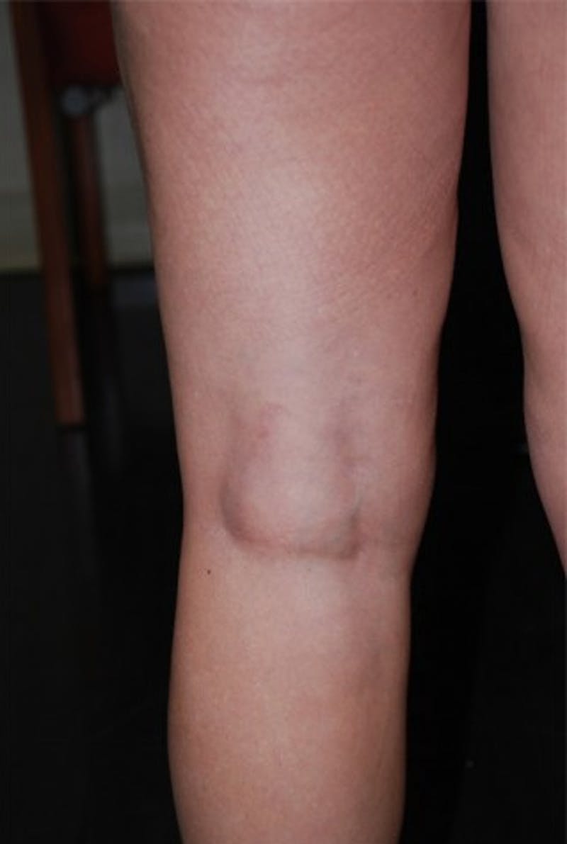 Spider Vein Treatment Before & After Gallery - Patient 174163249 - Image 4