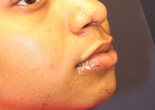 Complex Facial Reconstruction after Cancer and Trauma Before & After Gallery - Patient 174163278 - Image 4