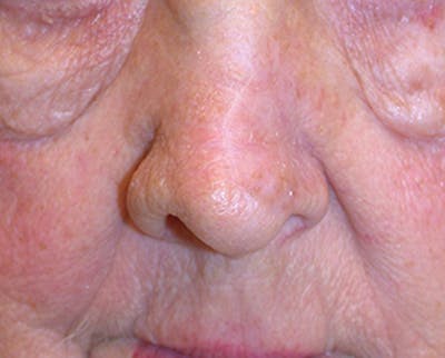 Complex Facial Reconstruction after Cancer and Trauma Before & After Gallery - Patient 174163290 - Image 2