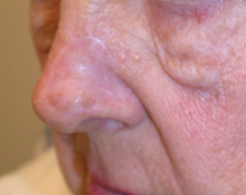 Complex Facial Reconstruction after Cancer and Trauma Before & After Gallery - Patient 174163290 - Image 4