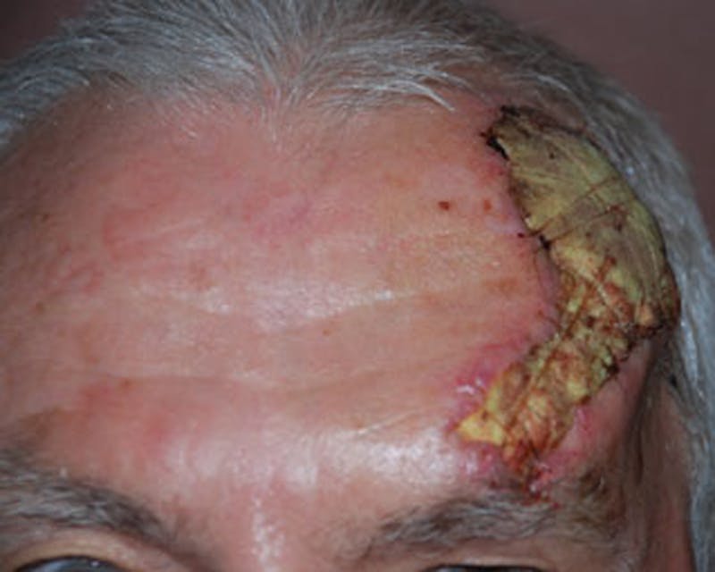 Complex Facial Reconstruction after Cancer and Trauma Before & After Gallery - Patient 174163295 - Image 1
