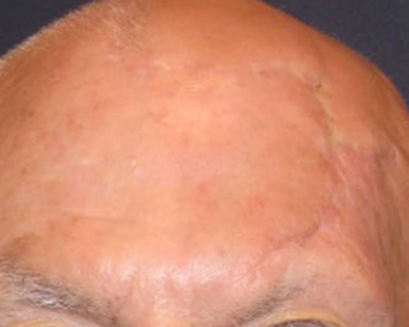Complex Facial Reconstruction after Cancer and Trauma Before & After Gallery - Patient 174163295 - Image 2