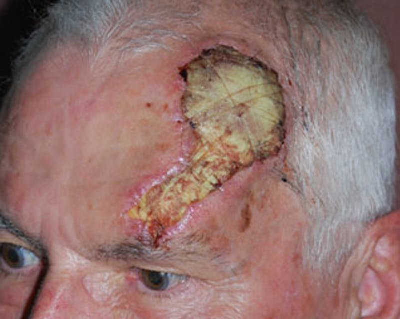Complex Facial Reconstruction after Cancer and Trauma Before & After Gallery - Patient 174163295 - Image 3