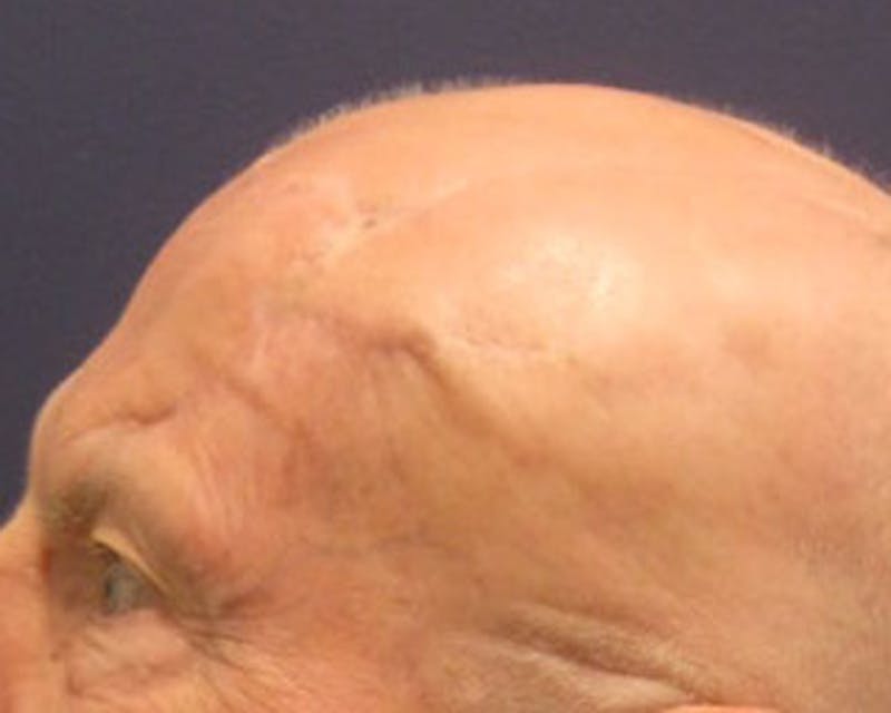Complex Facial Reconstruction after Cancer and Trauma Before & After Gallery - Patient 174163295 - Image 4