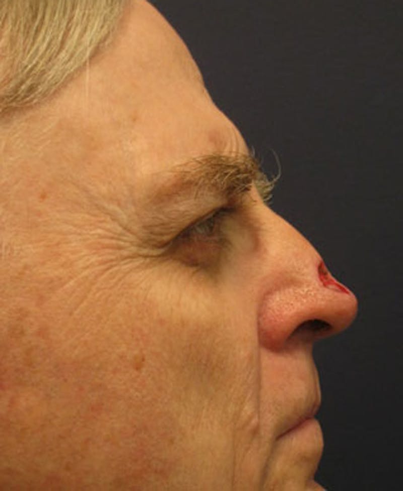 Complex Facial Reconstruction after Cancer and Trauma Before & After Gallery - Patient 174163301 - Image 5