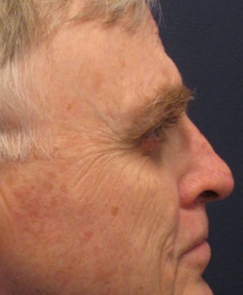 Complex Facial Reconstruction after Cancer and Trauma Before & After Gallery - Patient 174163301 - Image 6