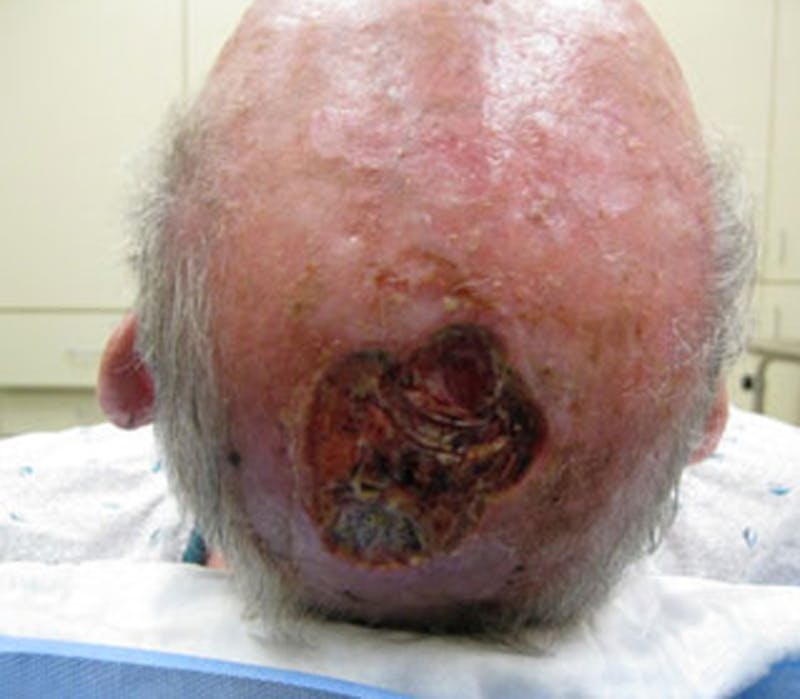 Complex Facial Reconstruction after Cancer and Trauma Before & After Gallery - Patient 174163309 - Image 3