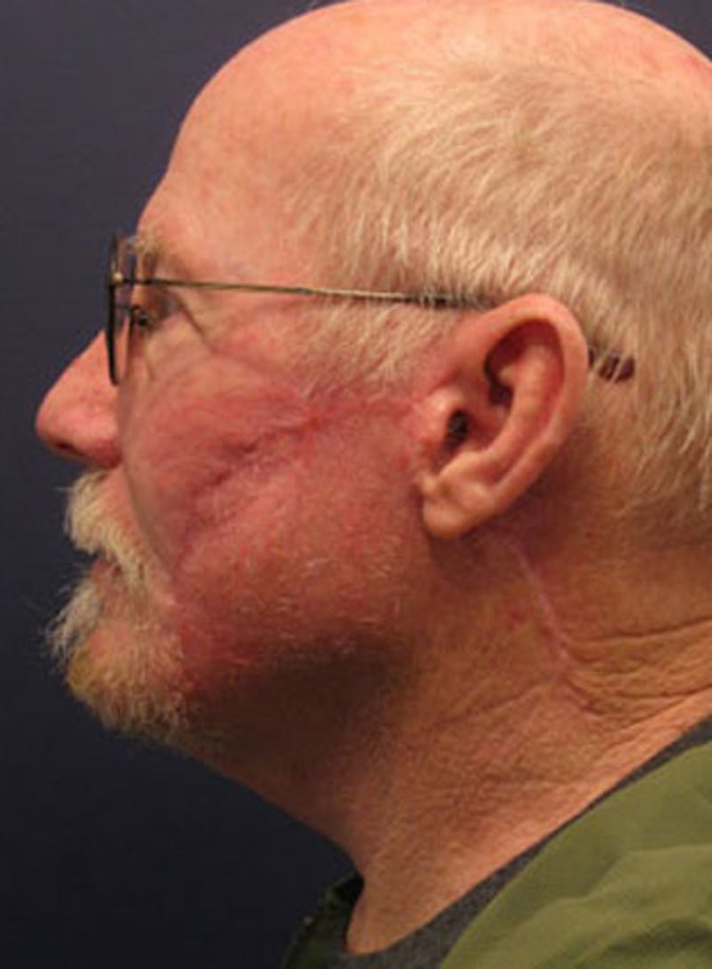 Complex Facial Reconstruction after Cancer and Trauma Before & After Gallery - Patient 174163315 - Image 2
