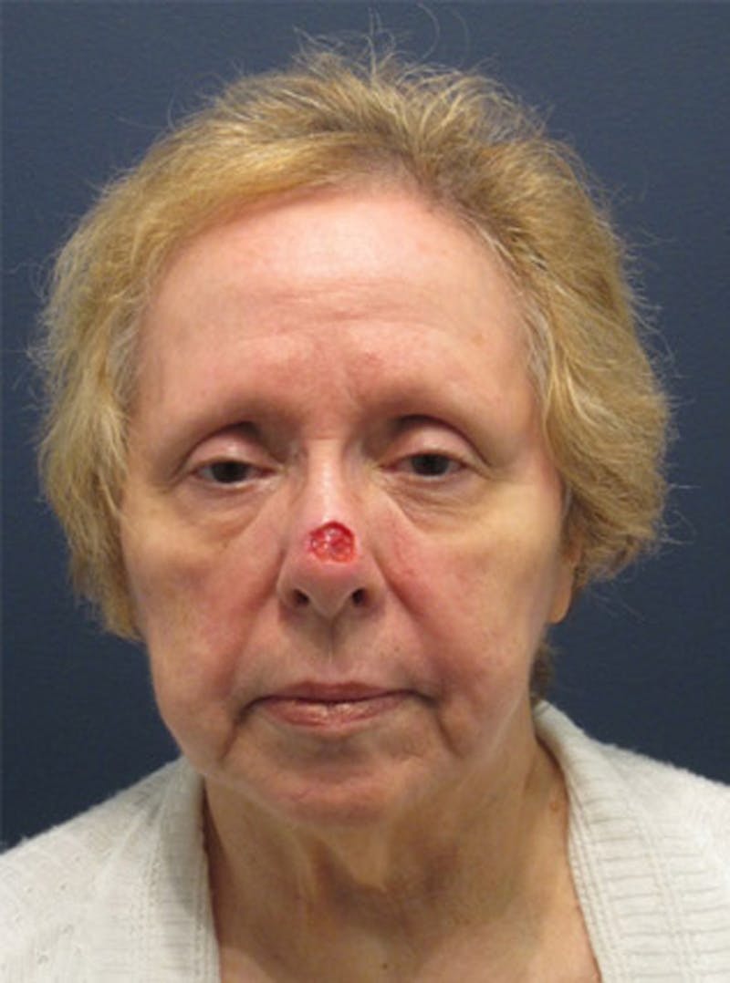 Complex Facial Reconstruction after Cancer and Trauma Before & After Gallery - Patient 174163321 - Image 1